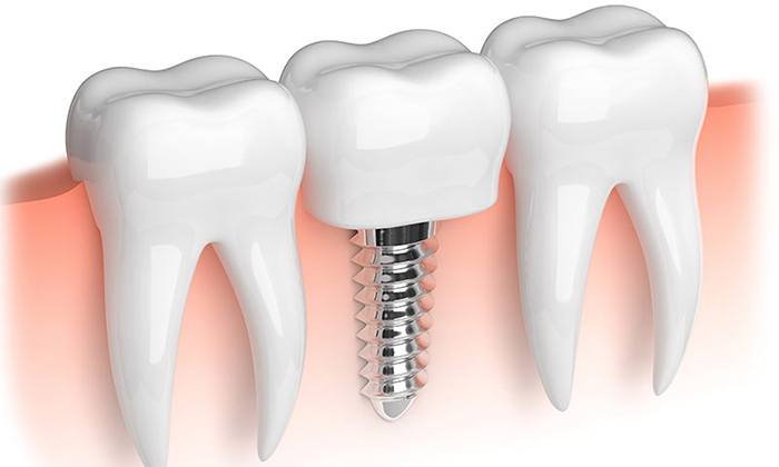 servicio implantes dentales