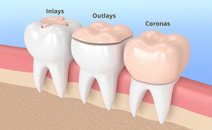 incrustaciones de porcelana